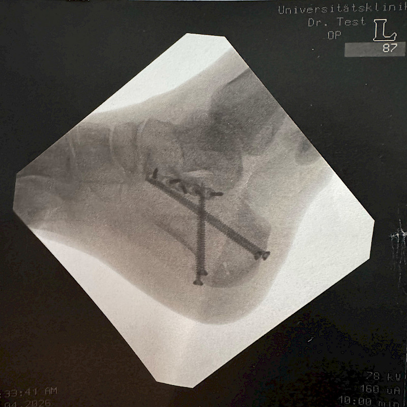 Radiografia di un piede con impianti metallici per la stabilizzazione.