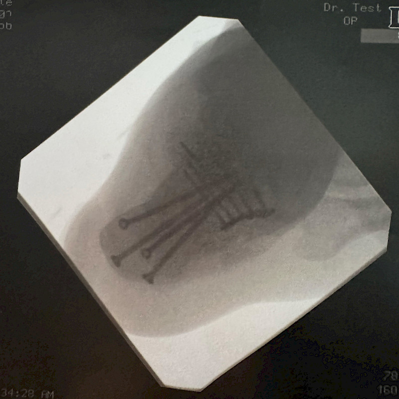 Radiografia di un piede con viti e placche chirurgiche visibili.